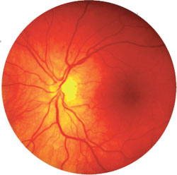 ИСЧЕЗАЮЩИЕ СОСУДЫ 