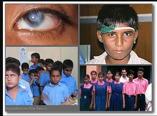 Более 50 процентов случаев слепоты у детей в Индии поддается лечению.