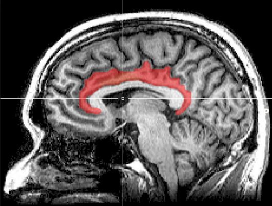 Поясная извилина является частью лимбической системы: изображение Mri cingulate cortex Sutudy Blue